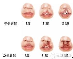 成人唇腭裂正畸视频大全,全方位解析矫正技巧与案例