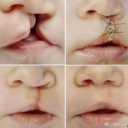 成人唇腭裂正畸视频大全,全方位解析矫正技巧与案例