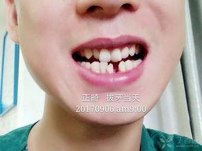 成人唇腭裂正畸视频大全,全方位解析矫正技巧与案例